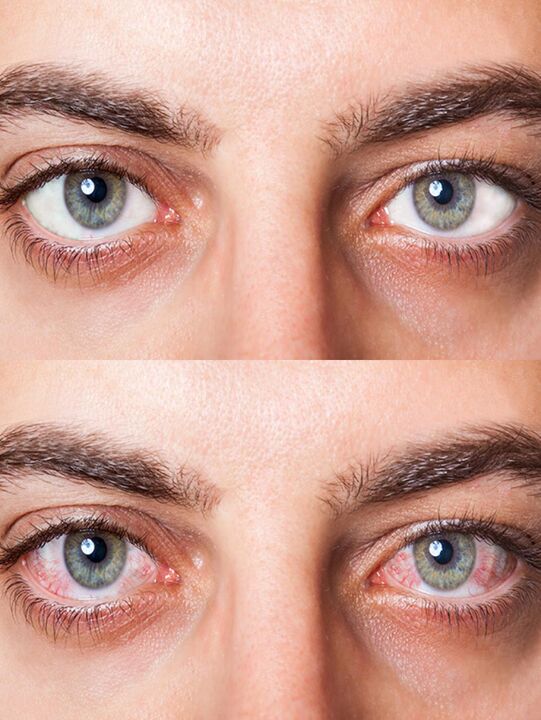 antes y después del tratamiento con gotas Oculear